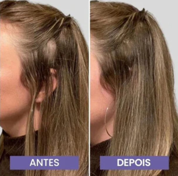 Escova de Terapia Capilar - LumiHair 4 em 1